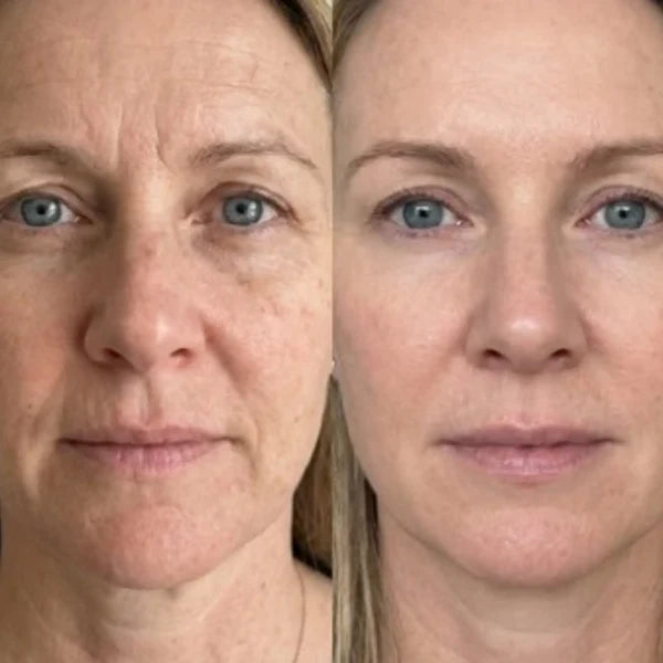 Före och efter – Anna S, 53 år